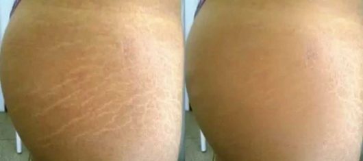 HIFU- STRETCH MARKS BEFORE & AFTER PHOTO 2
