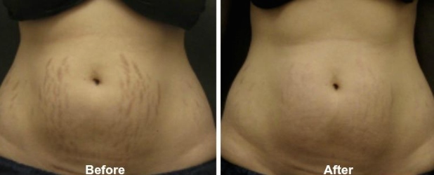 HIFU- STRETCH MARKS BEFORE & AFTER PHOTO